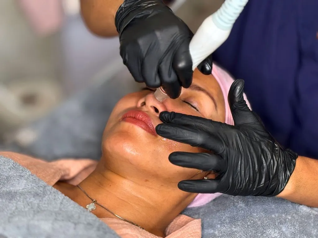 Extraction des points noirs du nez